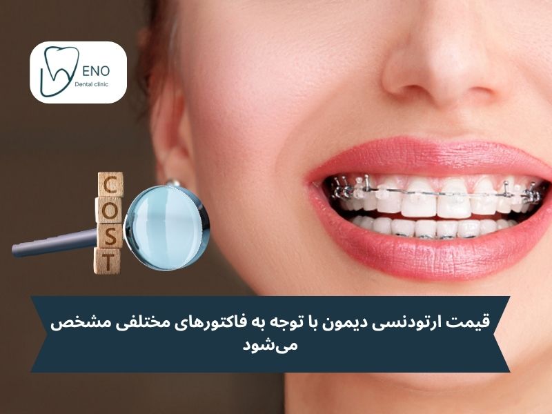 قیمت ارتودنسی دیمون
