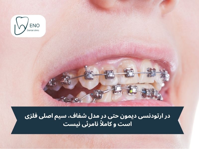 معایب بریسهای دیمون