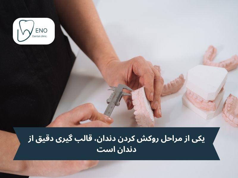 یکی از مراحل روکش کردن دندان، قالب گیری دقیق از دندان است
