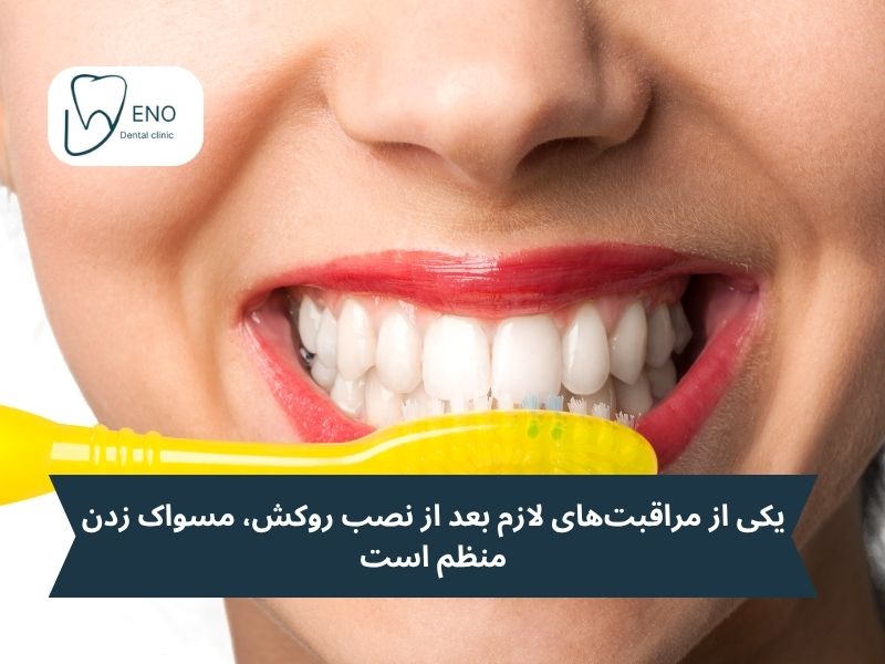 یکی از مراقبتهای لازم بعد از نصب روکش، مسواک زدن منظم است