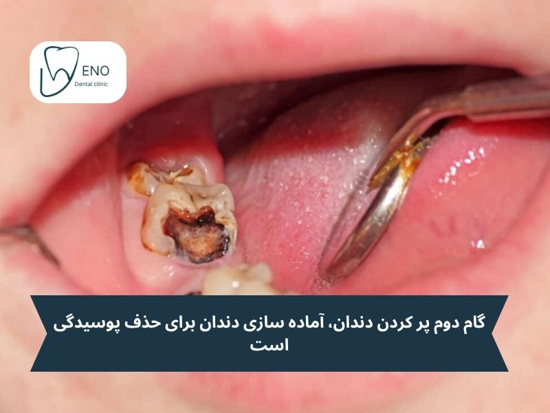 گام دوم پر کردن دندان، آماده سازی دندان برای حذف پوسیدگی است