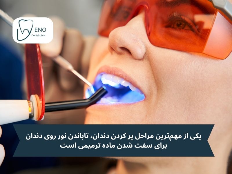 یکی از مهمترین مراحل پر کردن دندان، تاباندن نور روی دندان برای سفت شدن ماده ترمیمی است