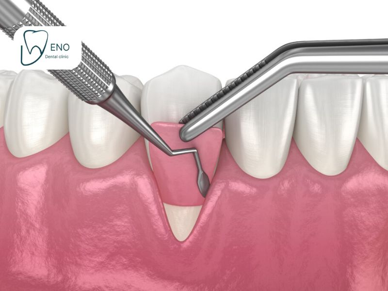 مراقبت های بعد از جراحی لثه
