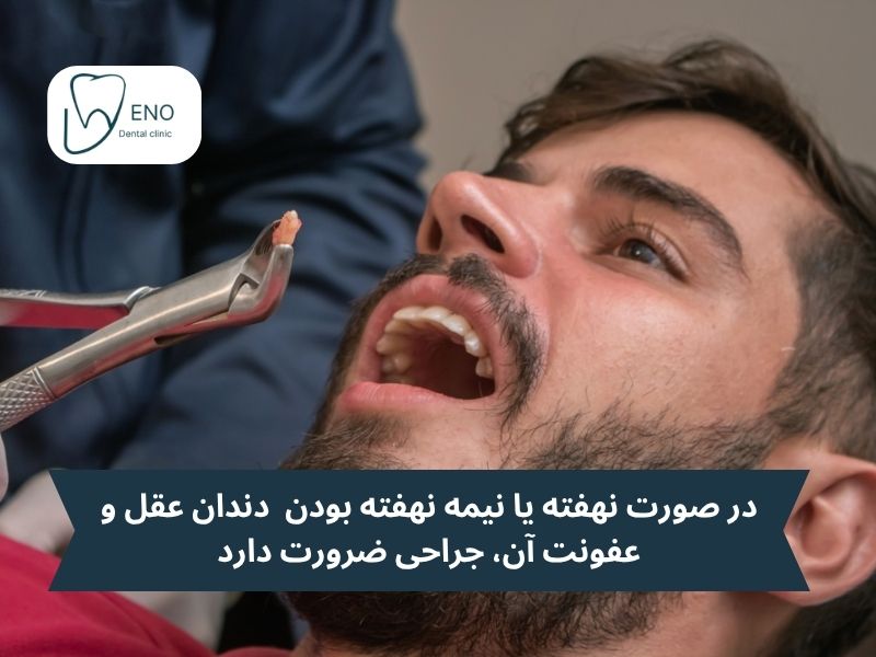 چه زمانی جراحی دندان عقل ضرورت دارد