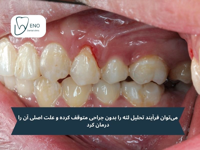 آیا درمان لثه تحلیل رفته بدون جراحی واقعیت دارد