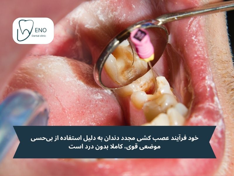 آیا عصب کشی مجدد دندان درد دارد