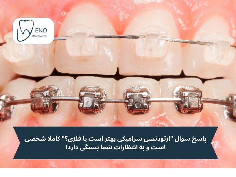 ارتودنسی سرامیکی بهتر است یا فلزی