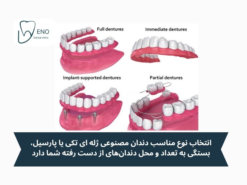 انواع دندان مصنوعی ژلهای؛ برای نیازهای مختلف