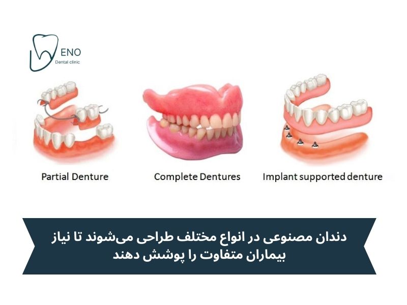 انواع دندان مصنوعی