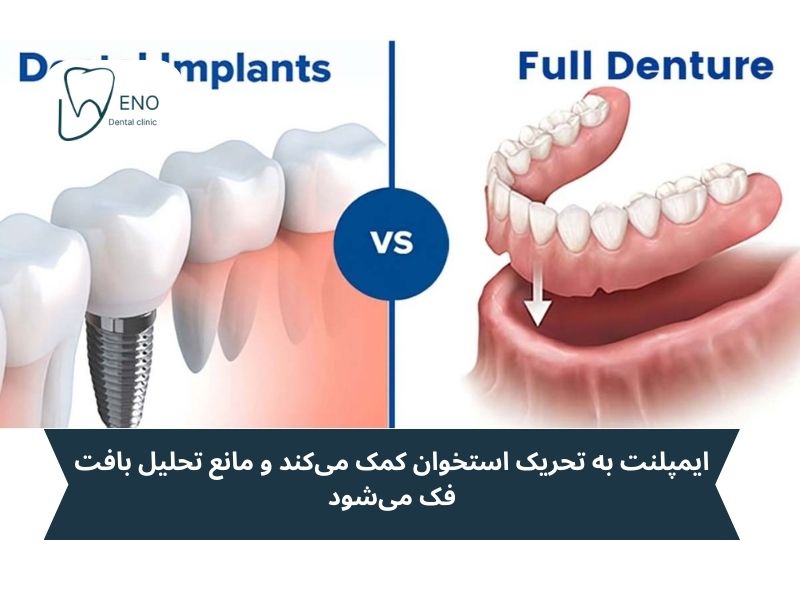 ایمپلنت بهتر است یا دندان مصنوعی