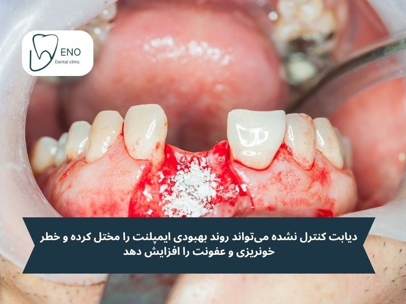 بیماریهای زمینهای و ایمپلنت