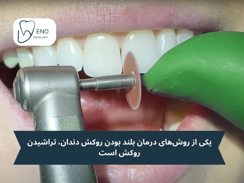 روشهای درمان بلند بودن روکش دندان