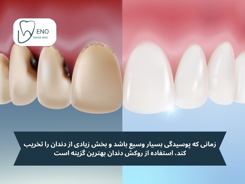 روکش دندان برای پوسیدگی