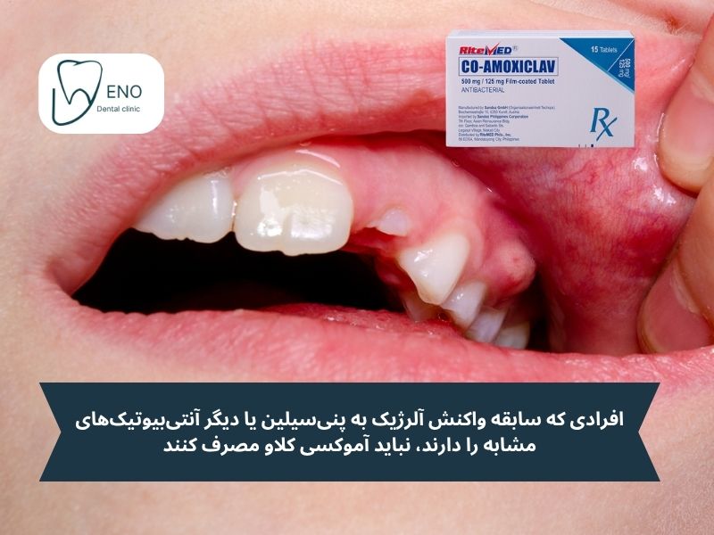موارد منع مصرف آموکسی کلاو برای عفونت دندان