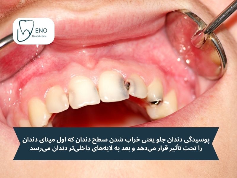 پوسیدگی دندان جلو چیست