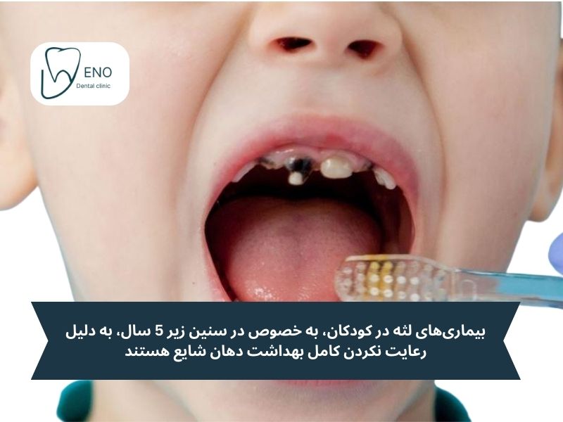 علت سیاه شدن لثه کودکان عدم رعایت بهداشت است