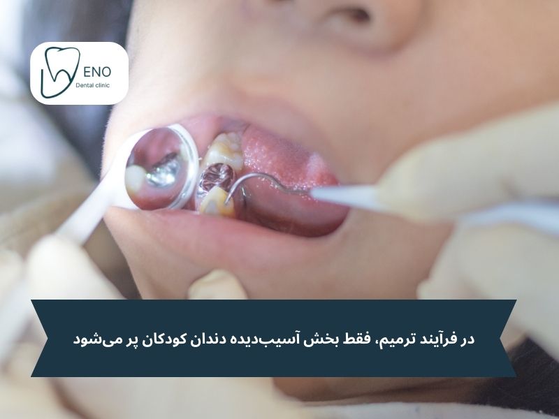 ترمیم دندان کودکان
