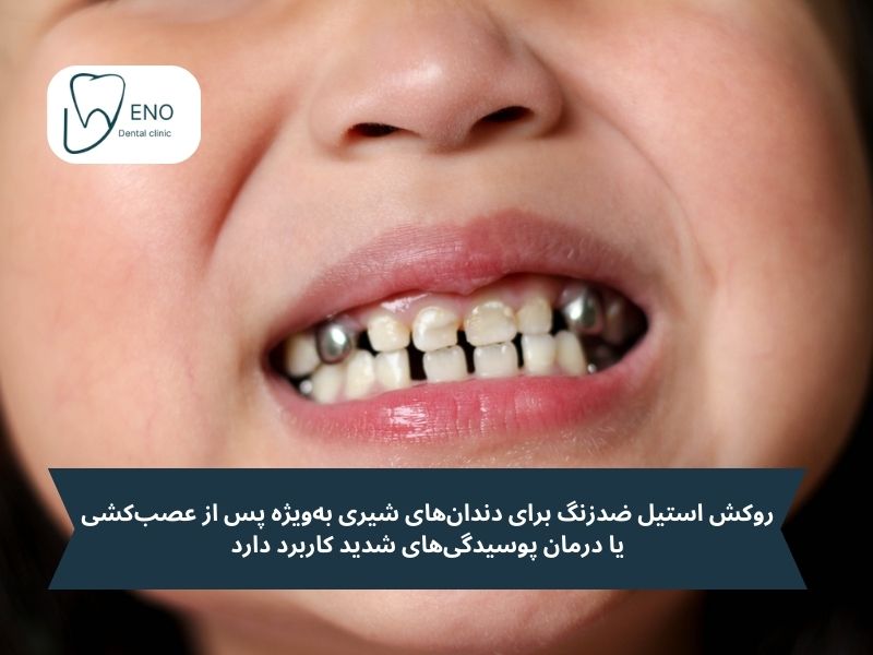 روکش استیل ضد زنگ کودکان