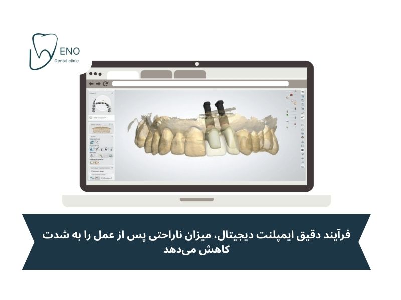 مراحل کاشت ایمپلنت دیجیتال