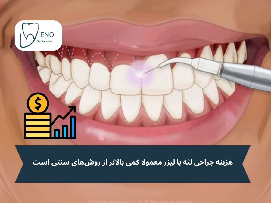 هزینه جراحی لثه با لیزر چقدر است؟