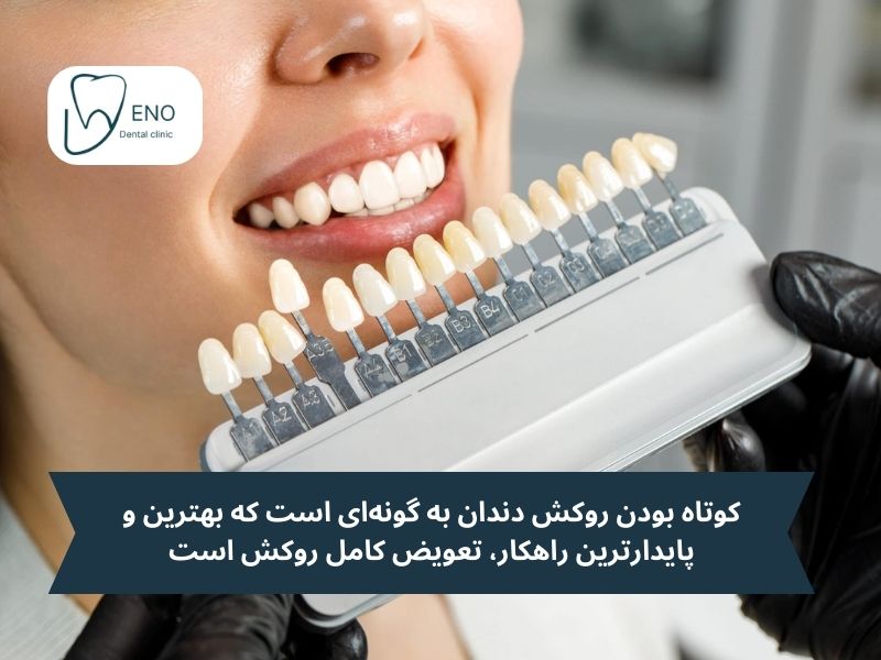 کوتاه بودن روکش دندان