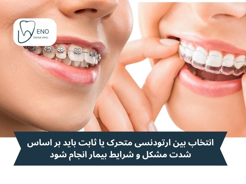 ارتودنسی متحرک و ثابت