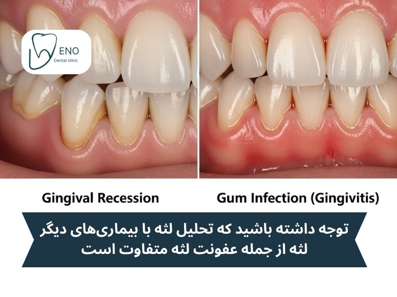 تفاوت تحلیل لثه با بیماریهای دیگر لثه