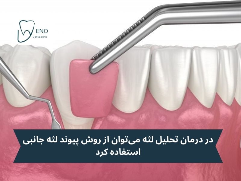 درمانهای جراحی تحلیل لثه چیست