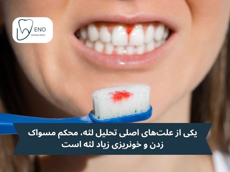 علتهای اصلی تحلیل لثه چیست