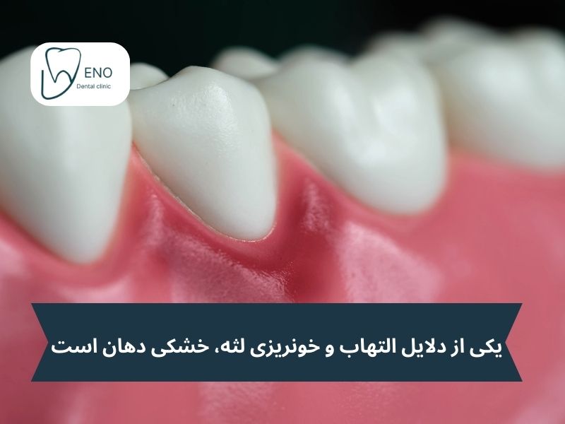 التهاب لثه و خشکی دهان
