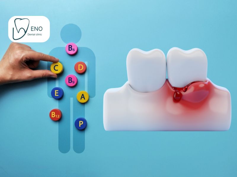 کمبود کدام ویتامین باعث خونریزی لثه میشود